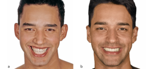 5 Ways to Design a Smile That Harmonizes Your Whole Face
