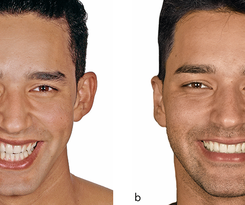 5 Ways to Design a Smile That Harmonizes Your Whole Face