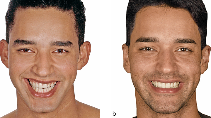 5 Ways to Design a Smile That Harmonizes Your Whole Face